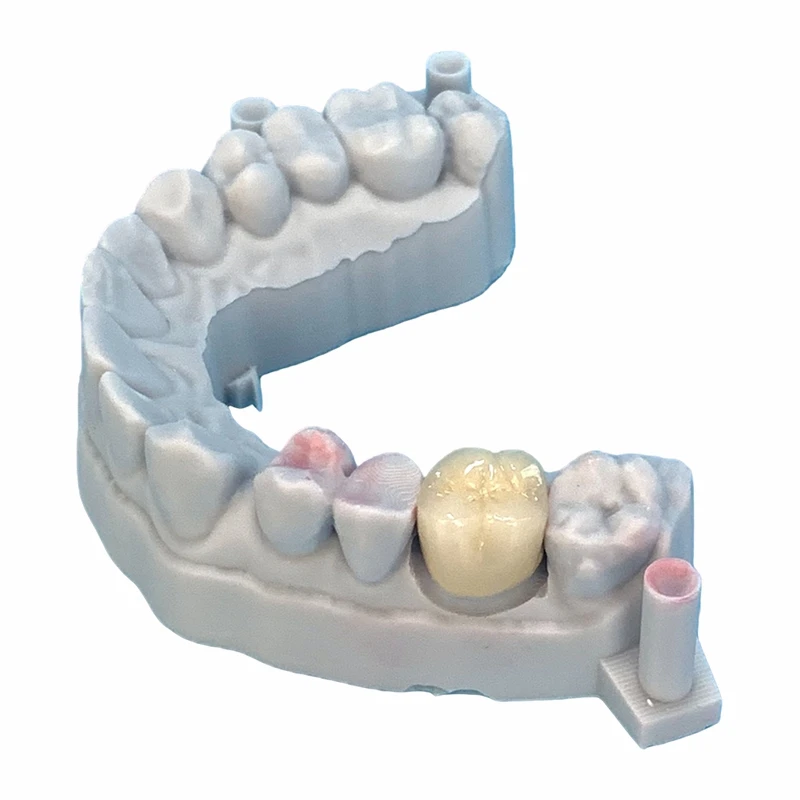 Co-Cr Metal-Ceramic Crown